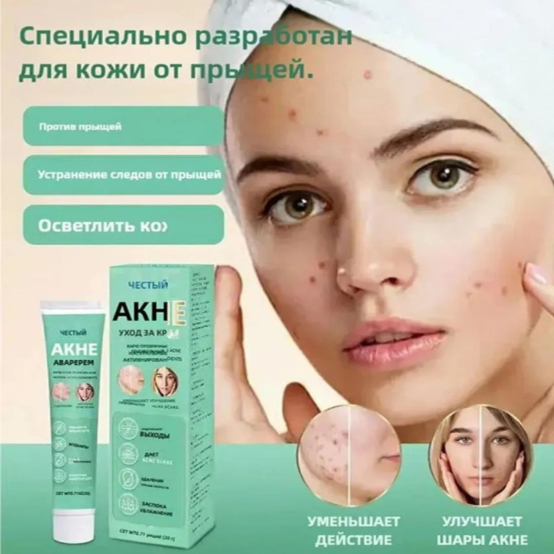 HBESTY Гель для лица, лечение акне и прыщей 20 г