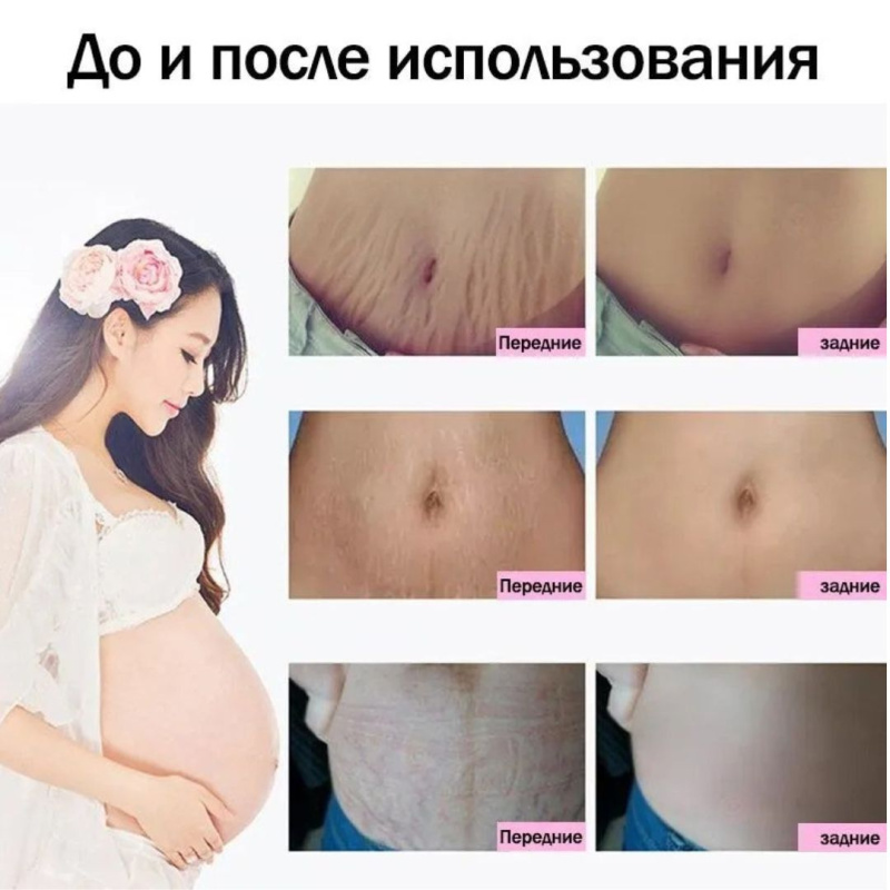 Anti-Stretch Mark Cream от Растяжек и Рубцов до и после родов, 60 г Anti-Stretch Mark Cream от Растяжек и Рубцов до и после родов, 60 г