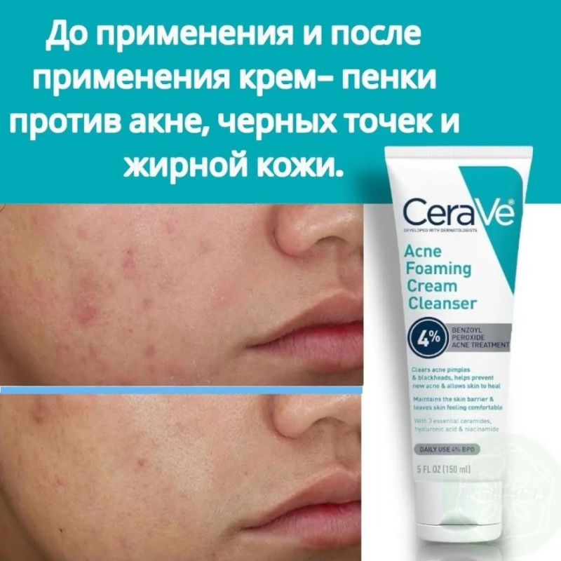 CeraVe Очищающая крем-пенка от прыщей 4% CeraVe Acne Foaming Cream Cleanser 150 мл CeraVe Очищающая крем-пенка от прыщей 4% CeraVe Acne Foaming Cream Cleanser 150 мл